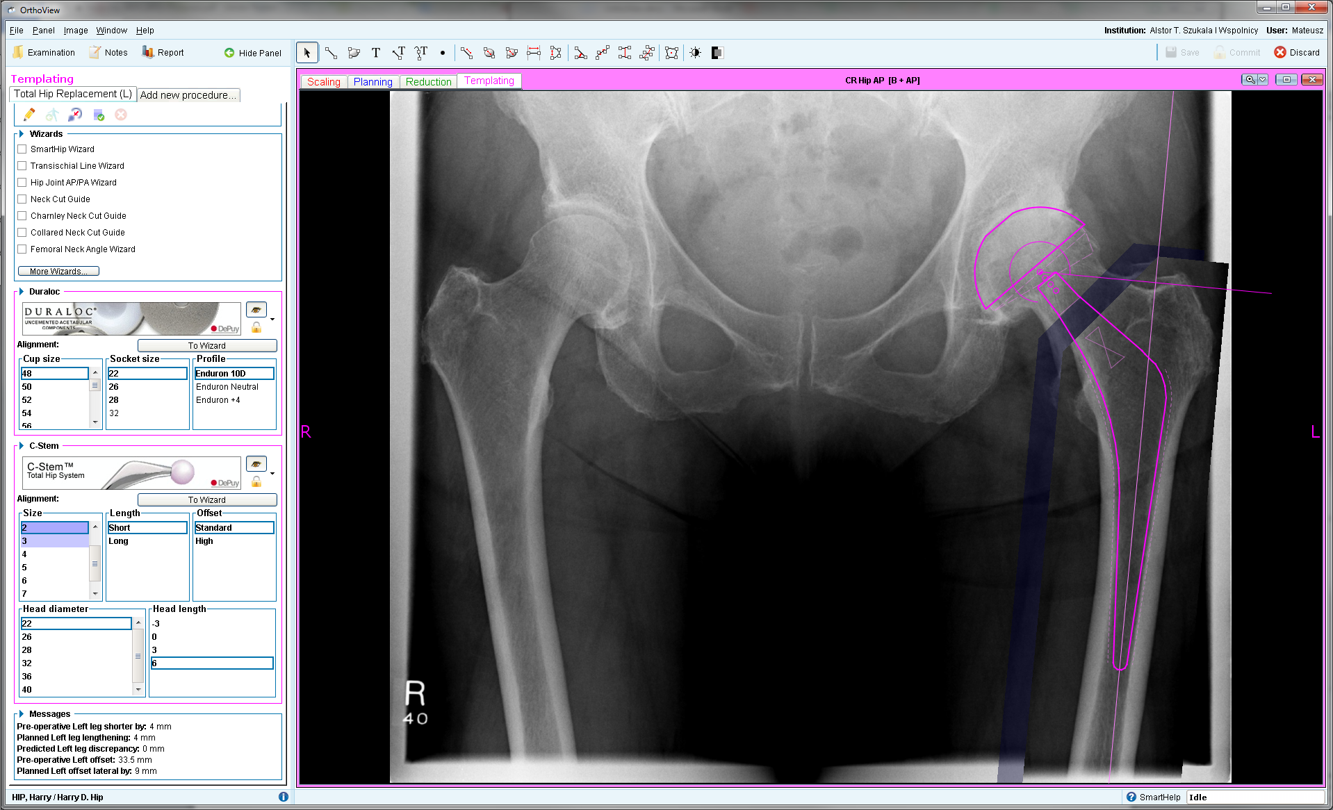 OrthoView - oprogramowanie do przedoperacyjnego planowania implantacji protez stawów oraz leczenia ortopedycznego